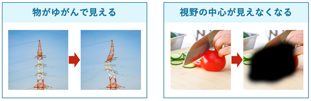 物がゆがんで見える_視野の中心が見えない 物がゆがんで見える_視野の中心が見えない